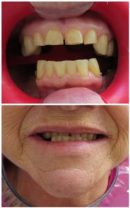 recuperação dvo (facetas) - marilene (8)